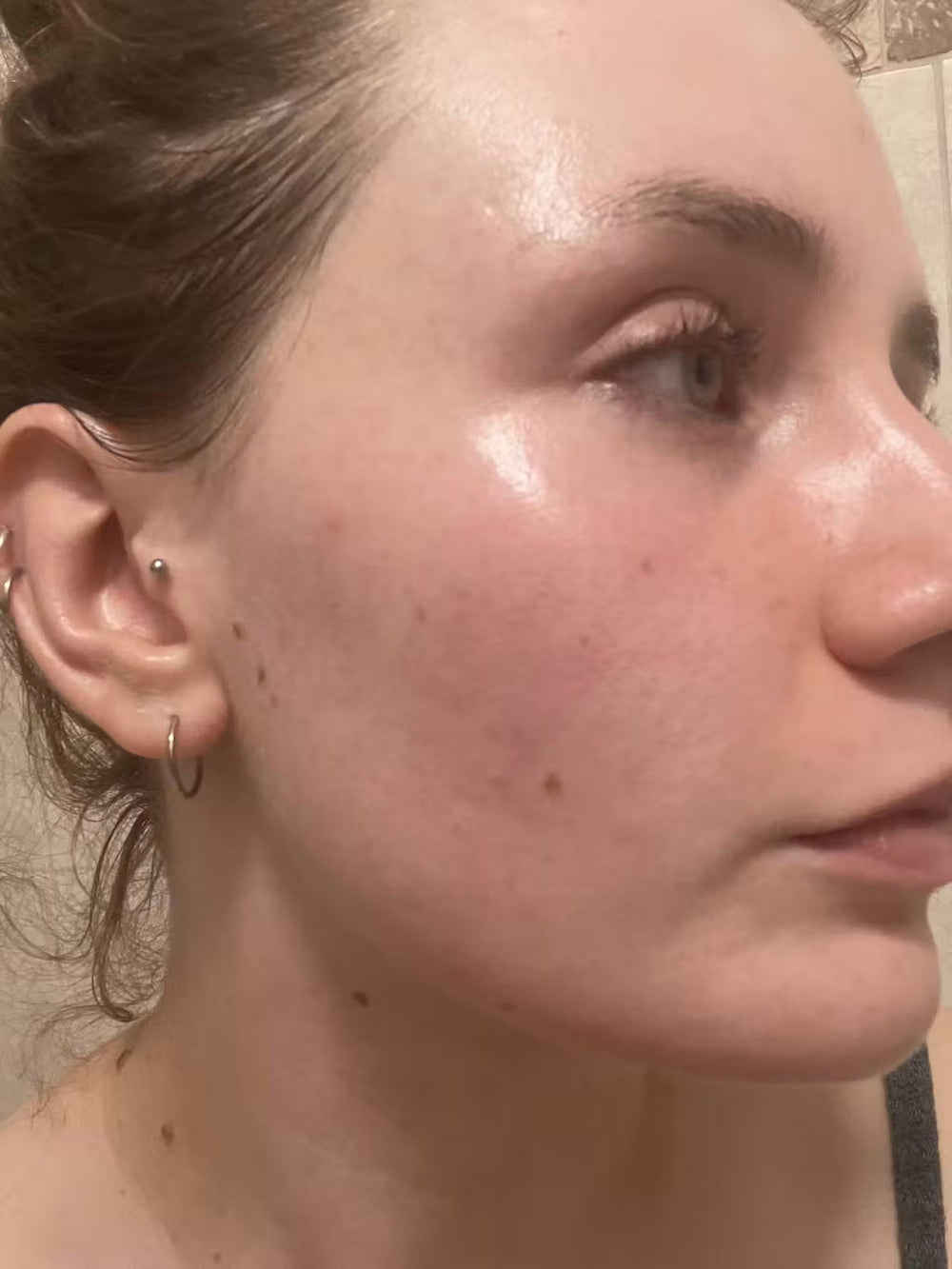 acne NL keep